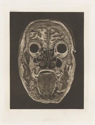 Atlas of head sections : fifty-three engraved copperplates of frozen sections of the head and fifty-three key plates with descriptive texts / by William Macewen.