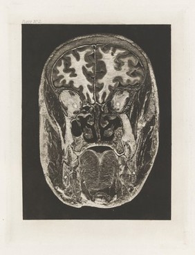 Atlas of head sections : fifty-three engraved copperplates of frozen sections of the head and fifty-three key plates with descriptive texts / by William Macewen.