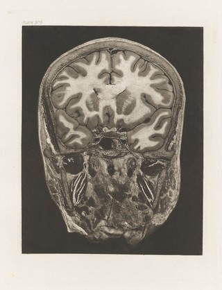 Atlas of head sections : fifty-three engraved copperplates of frozen sections of the head and fifty-three key plates with descriptive texts / by William Macewen.