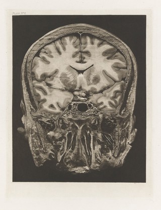 Atlas of head sections : fifty-three engraved copperplates of frozen sections of the head and fifty-three key plates with descriptive texts / by William Macewen.