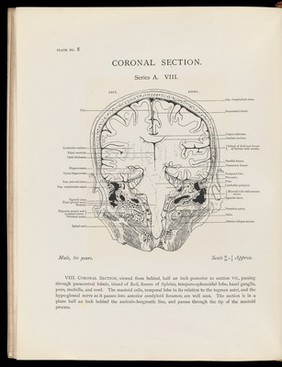 Atlas of head sections : fifty-three engraved copperplates of frozen sections of the head and fifty-three key plates with descriptive texts / by William Macewen.