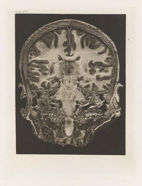 Atlas of head sections : fifty-three engraved copperplates of frozen sections of the head and fifty-three key plates with descriptive texts / by William Macewen.