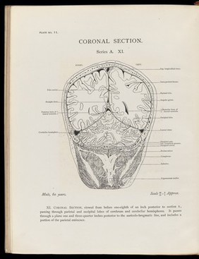 Atlas of head sections : fifty-three engraved copperplates of frozen sections of the head and fifty-three key plates with descriptive texts / by William Macewen.