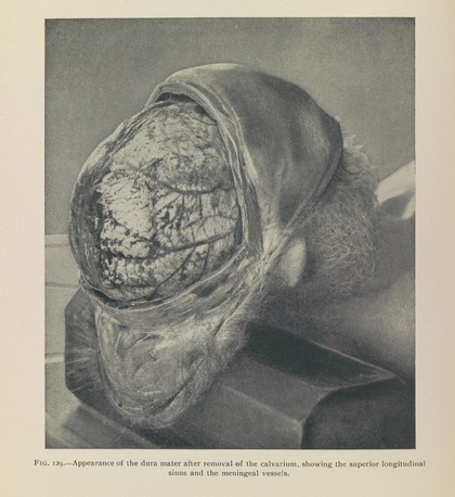 Post-mortem pathology : a manual of post-mortem examinations and the interpretations to be drawn therefrom a practical treatise for students and practitioners / by Henry W. Cattell.