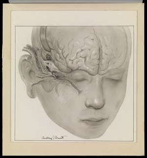 view Cerebrospinal rhinorrhoea. Carbon dust drawing by A.J. Arnott.