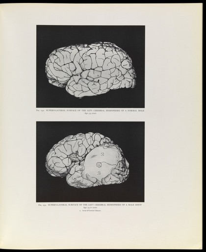 A cerebral atlas : illustrating the difference between the brains of mentally defective and normal individuals, with a social, mental and neurological record of 120 defectives during life / by Richard J.A. Berry.