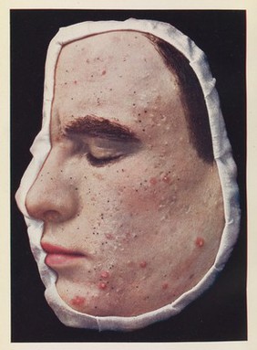 Acne Vulgaris