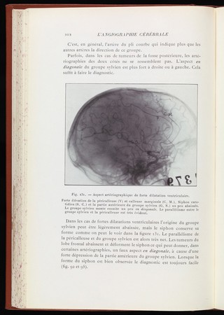 L'angiographie cérébrale : ses applications et résultats en anatomie, physiologie et clinique. Avec 192 figures originales / [Egas Moniz].