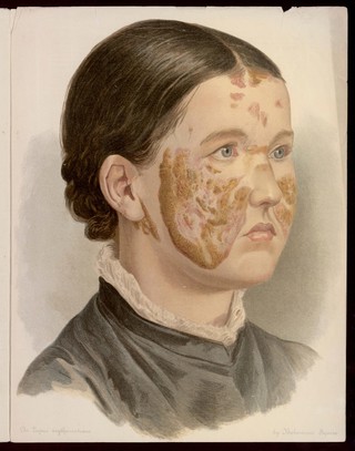 On lupus erythematosus; or bat's-wing disease / by Balmanno Squire.