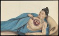 view A woman, reclining, with a large tumour on her left breast. Gouache, 18--, after Lam Qua, ca. 1837.