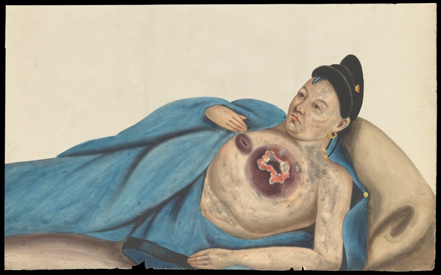 A woman, reclining, with a large tumour on her left breast. Gouache, 18--, after Lam Qua, ca. 1837.