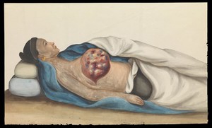 view A woman, reclining, with a large tumour on her right breast. Gouache, 18--, after Lam Qua, ca. 1837.