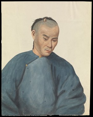 view A man with a cutaneous horn-like growth on the scalp. Gouache, 18--, after Lam Qua, ca. 1837.