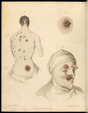 An essay on the venereal diseases which have been confounded with symptoms, which exclusively arise from that poison ... / [Richard Carmichael].