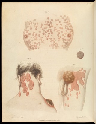 An essay on the venereal diseases which have been confounded with symptoms, which exclusively arise from that poison ... / [Richard Carmichael].