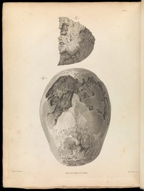 A series of engravings, accompanied with explanations, which are intended to illustrate the morbid anatomy of some of the most important parts of the human body / [Matthew Baillie].