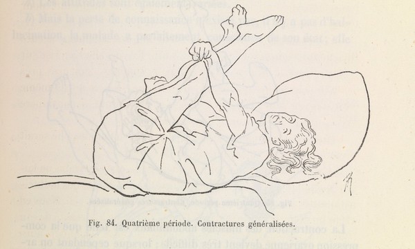 Études cliniques sur l'hystéro-épilepsie ou grande hystérie / par Paul Richer ; précédé d'une lettre-préface de J.-M. Charcot.