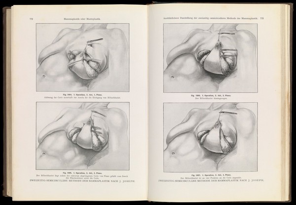 Nasenplastik und sonstige Gesichtsplastik : nebst einem Anhang über Mammaplastik und einige weitere Operationen aus dem Gebiete der äusseren Körperplastik ein Atlas und Lehrbuch / von J. Joseph.