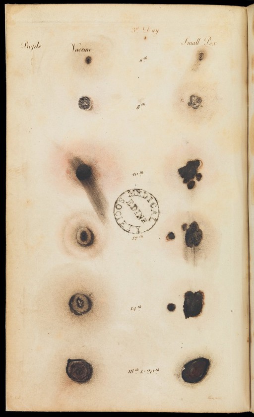 Comparative view of vaccine and small-pox stages