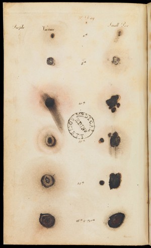 view Comparative view of vaccine and small-pox stages