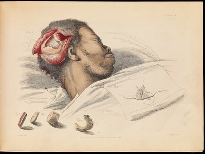 Plate II, illustration of trephination. Sir Charles Bell