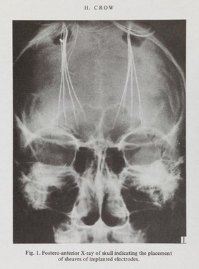 X-ray from "Psychosurgery and society"