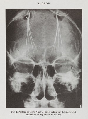 view X-ray from "Psychosurgery and society"