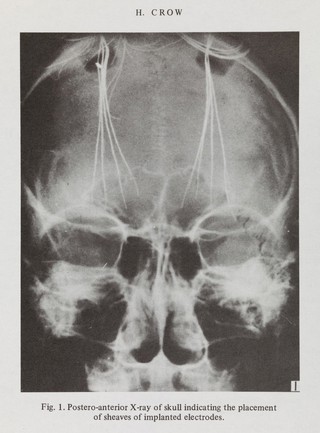 X-ray from "Psychosurgery and society"
