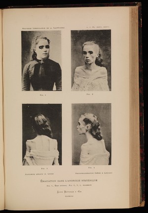 view Four photographs of a woman, showing anorexia nervosa
