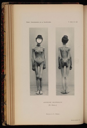 view Two photographs of a woman suffering from anorexia nervosa