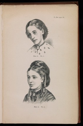 Two Woodcuts showing Miss A before and after treatment