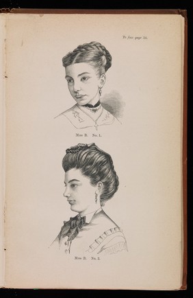 Two Woodcuts showing Miss B before and after treatment