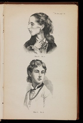 Two Woodcuts showing Miss C before and after treatment