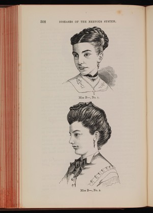 view Two woodcuts showing Miss B before and after treatment