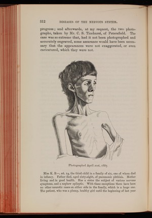 view Miss K. R- aged 14, before treatment for anorexia