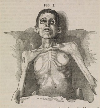 A woman suffering from extreme emaciation (anorexia nervosa)