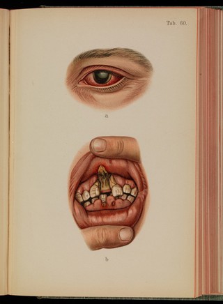 Atlas of syphilis and the veneral diseases : including a brief treatise on the pathology and treatment / by Prof. Dr. Franz Mraček, edited by L. Bolton Bangs.