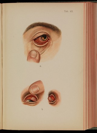 Atlas of syphilis and the veneral diseases : including a brief treatise on the pathology and treatment / by Prof. Dr. Franz Mraček, edited by L. Bolton Bangs.