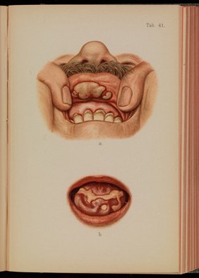 Atlas of syphilis and the veneral diseases : including a brief treatise on the pathology and treatment / by Prof. Dr. Franz Mraček, edited by L. Bolton Bangs.