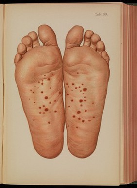 Atlas of syphilis and the veneral diseases : including a brief treatise on the pathology and treatment / by Prof. Dr. Franz Mraček, edited by L. Bolton Bangs.