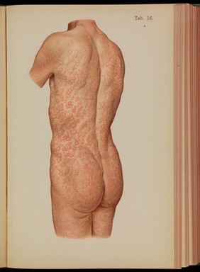 Atlas of syphilis and the veneral diseases : including a brief treatise on the pathology and treatment / by Prof. Dr. Franz Mraček, edited by L. Bolton Bangs.