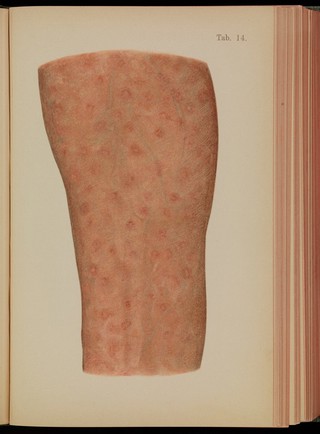 Atlas of syphilis and the veneral diseases : including a brief treatise on the pathology and treatment / by Prof. Dr. Franz Mraček, edited by L. Bolton Bangs.