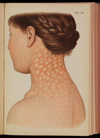 Atlas of syphilis and the veneral diseases : including a brief treatise on the pathology and treatment / by Prof. Dr. Franz Mraček, edited by L. Bolton Bangs.