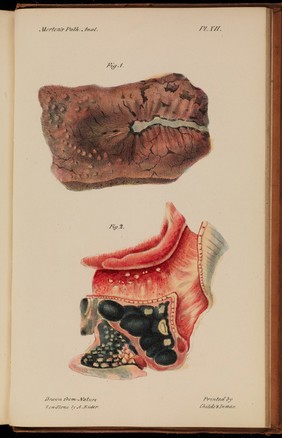 Illustrations of pulmonary consumption, its anatomical characters, causes, symptoms and treatment. With twelve plates, drawn and coloured from nature / By Samuel George Morton.