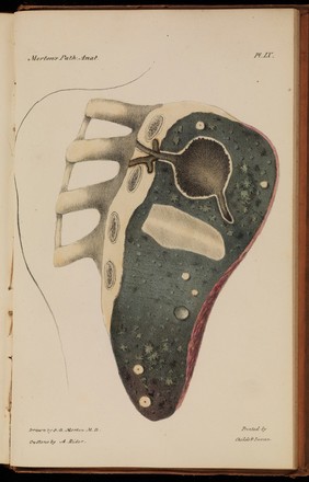 Illustrations of pulmonary consumption, its anatomical characters, causes, symptoms and treatment. With twelve plates, drawn and coloured from nature / By Samuel George Morton.