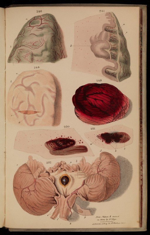 Figures 246-252. Tuberculosis in the brain.