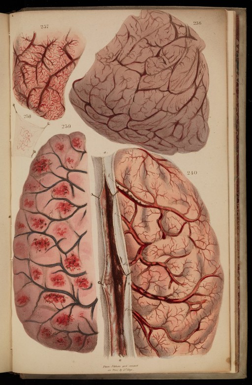 Figures 236-240. Dissection of tubercular brains.
