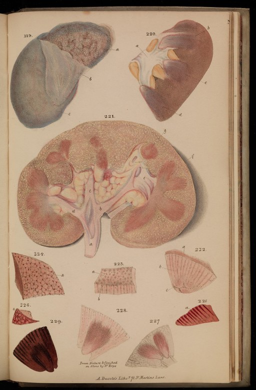 Figures 219-229. Tuberculosis in the kidneys.