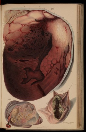 Principles and illustrations of morbid anatomy; adapted to the elements of M. Andral, and to the Cyclopaedia of practical medicine ... / being a complete series of coloured lithographic drawings from originals by the author; with descriptions and summary allusions to cases, symptoms, treatment, &c. ... By J. Hope.