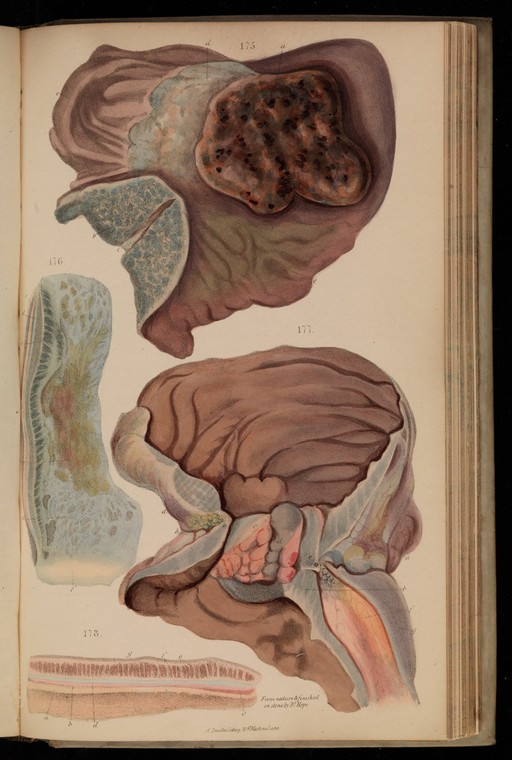 Figures 175-178, illustrations of morbid anatomy